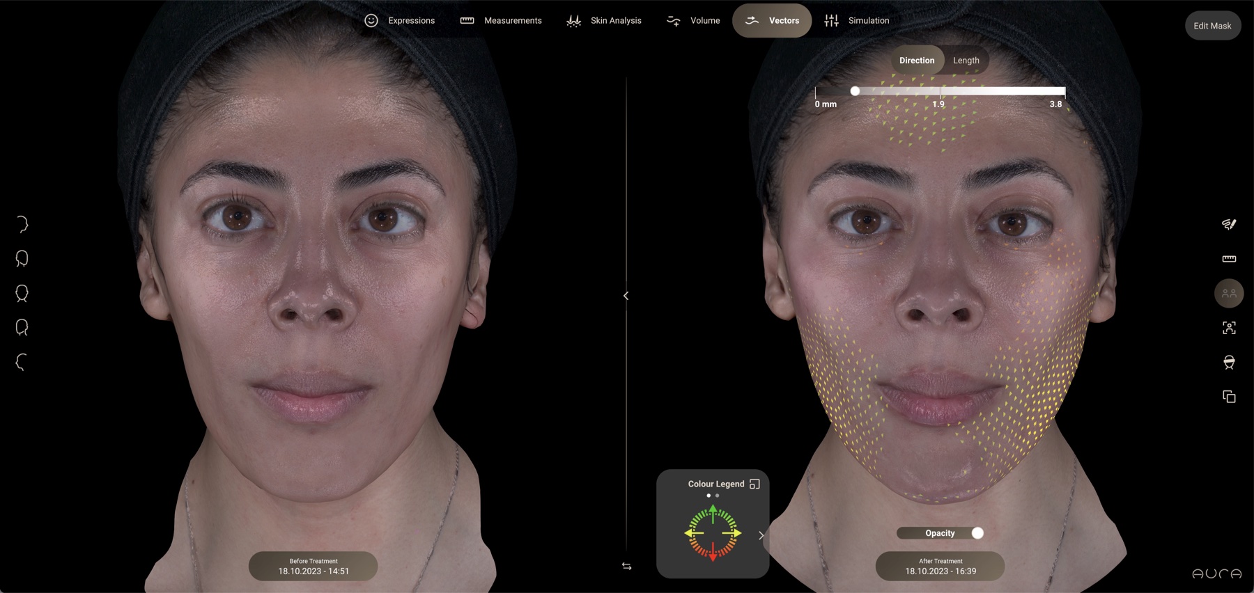 Aura vector analysis view: directional arrows showing where facial tissues have shifted