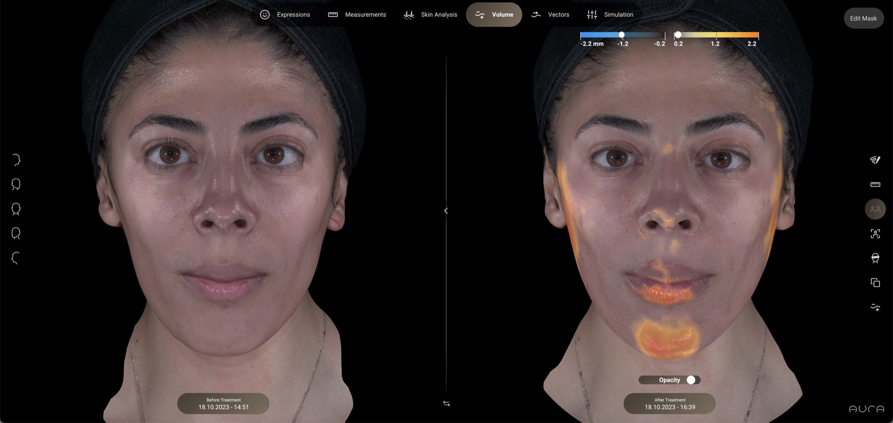 Aura volume difference view: 3D heat map of volume change between two scans